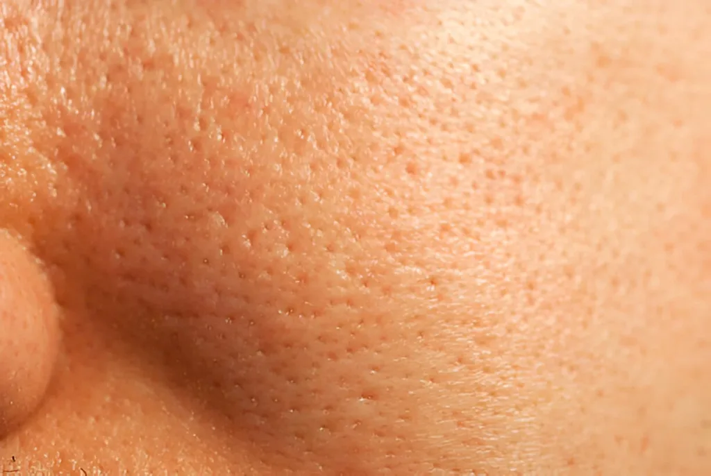 Acne serum, best serum for acne, anti acne serum, best serum for acne scars, anti acne face wash, serum with niacinamide, niacinamide serum